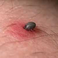 Клещ, впившийся в кожу